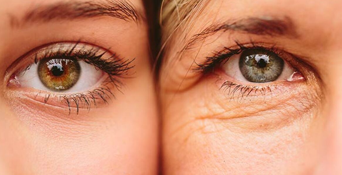 Vanjski znaci starenja kože oko očiju kod dvije žene različite dobi