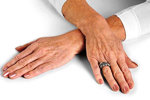 Koža ruku sa starosnim promenama koje zahtevaju upotrebu tehnika podmlađivanja