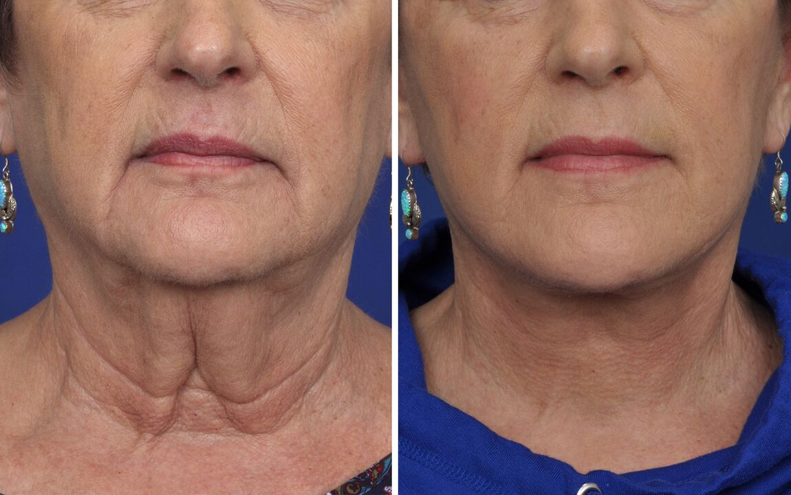 prije i poslije postupaka podmlađivanja kože