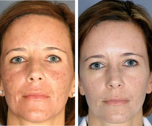 Prije i poslije frakcijske termolize lica