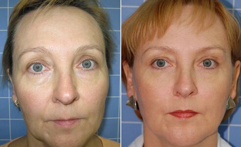 Prije i poslije frakcijskog laserskog podmlađivanja lica