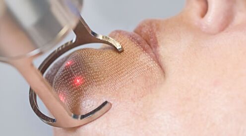 Tok postupka za frakciono lasersko podmlađivanje kože lica