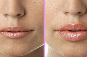 prije i poslije postupka obnove usana